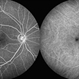 Macular Telangiectasia Type 2 Macular Telangiectasia Type 2